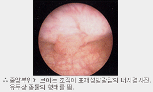 중앙부위에 보이는 조직이 표재성방광암의 내시경사진. 유두상 종물의 형태를 띔.