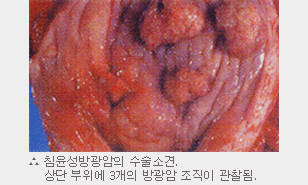 침윤성방광암의 수술소견. 상단 부위에 3개의 방광암 조직이 관찰됨.