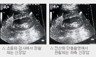 식도암의 증상