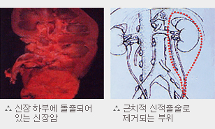 식도암의 증상