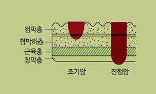 조기암과 진행암