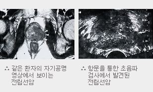 전립선암의 원인