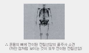 전립선암의 증상