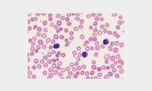 말초혈액 도말 사진