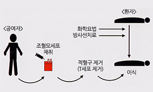 동종 조혈모세포(골수) 이식과정